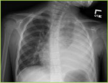 Figure 1. There is near complete opacification of the left hemithorax with a minimal area of aeration of the left upper lobe suggestive of left lung air space disease and with component of a moderate to large left pleural effusion.