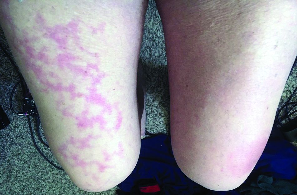 A reticular eruption on the thighs  Cleveland Clinic Journal of Medicine