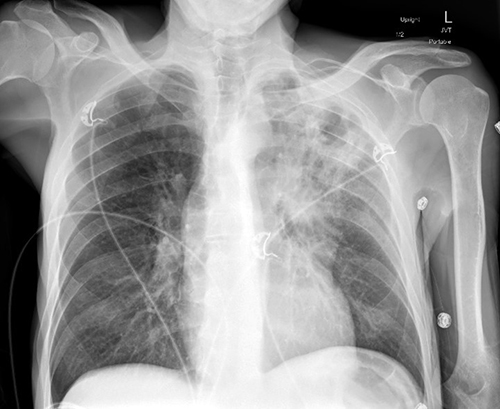 Figure 1: Chest X-ray of a hospitalized patient demonstrating a left upper lobe cavitary lung lesion.