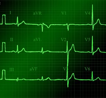 A patient's electrocardiogram is shown.