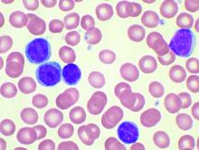 High-power magnification (1000 X) of a Wright's stained peripheral blood smear showing chronic lymphocytic leukemia (CLL). The lymphocytes with the darkly staining nuclei and scant cytoplasm are the CLL cells.