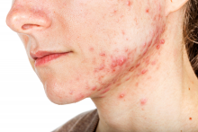 Mandibular acne on a woman's face