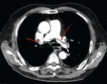 A large pulmonary embolism at the bifurcation of the pulmonary artery (saddle embolism).