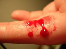 A bleeding finger