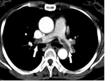 Pulmonary embolism