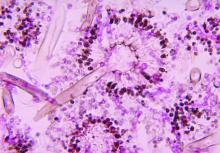 Aspergillosis histology shows the presence of conidial heads.