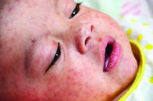 A baby with measles