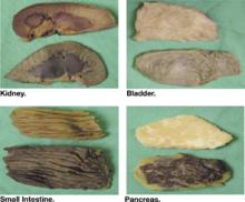 Gross autopsy photos: the patient's darkly pigmented organs are on the bottom in each image and normal specimens for comparison are on top.