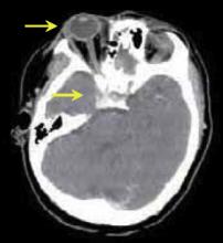 FIGURE 1. CT Scan showing exophthalmos and engorged cavernous sinus