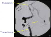 FIGURE 3. Post-coiling angiogram showing normal filling of the cavernous sinus and no ophthalmic veins.