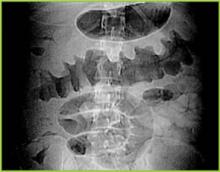 Figure 1 . Digital radiograph from CT scan shows nodular haustal thickening in the transverse colon.