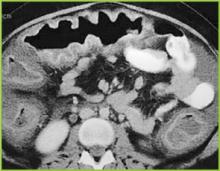Figure 2 . CT image of the upper abdomen confirms marked haustral thickening in the transverse colon.