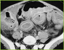 Figure 3 . CT image of the mid abdomen demonstrates marked thickening of the entire colon. Mild inflammatory changes are present in the pericolonic fat.