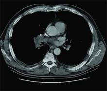 A CT scan of the patient's chest.