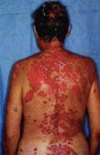 The patient presented with extensive necrotic coalescing erythematous weeping vesicles and bullae.