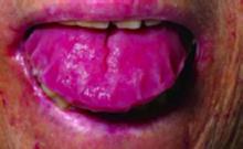 The 48-year-old patient's enlarged tongue.