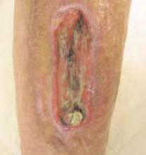 Figure 1: This patient had a malignant tumor of the leg removed and underwent post-operative radiotherapy. The wound contains necrosis and slough. An earlier sharp debridement and split skin graft produced no effect.