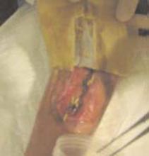 Figure 2: The full-grown maggots are removed after three days of treatment. There is no necrosis left. The wound was treated with four applications with a total of 145 maggots. The wound was subsequently treated with vacuum-assisted closure therapy and secondarily closed.