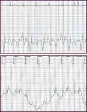 Figure 1. RA = right atrial pressures, PCWP = pulmonary capillary wedge pressure