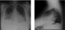 Figure 2. Posteroanterior and lateral chest X-rays showing basilar infiltrates and an enlarged cardiac silhouette