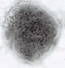 This negative stained transmission electron micrograph (TEM) depicts the ultrastructural features displayed by the mumps virus.