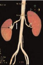 Figure 1. 3D CT angiogram.