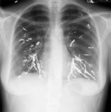 Chest X-ray reveals embolization coils.