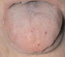 Superficial telangiectasias of the tongue.