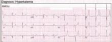 EKG in patient with hyperkalemia.