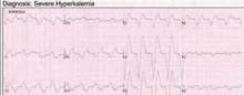 EKG of patient with more advanced hyperkalemia.