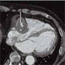 Figure 1: Coronary CT angiogram