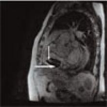 Figure 2: SSFGRE coronal MRI