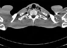 Figure 1: Paratracheal air