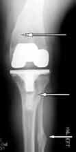 Figure 2: Old fracture deformities