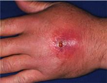 Cellulitis is a skin and soft-tissue infection that is most commonly identified by tenderness, erythema, swelling, and fever. Treatment should include a parenteral antiobiotic that provides coverage for MRSA.