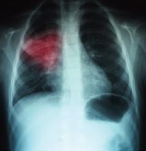A chest X-ray highlighting right-middle-lobe pneumonia.
