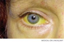A female patient with jaundice caused by liver disease. Discoloration is due to high levels of the bile pigment bilirubin, which can extend to other tissues and body fluids.
