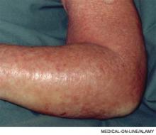 Left-arm edema and erythema associated with an axillary vein thrombosis.