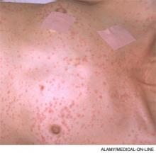 Petechial rash on anterior upper body, characteristic of fat emboli syndrome.
