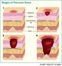 Stages of Pressure Sores