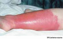 Acute, left-lower-extremity cellulitis.