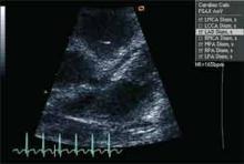 Echocardiogram - view of left anterior descending artery
