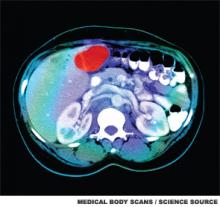 This is a cross sectional image from a CT scan of the abdomen which shows an ill-defined tumor in the liver. The tumor is the red area in the top part of the liver, located next to the gallbladder. The spine (vertebrae) is the white structure near the center of the lower part of the image. To either side of the spine are the kidneys.