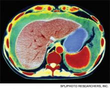 Colored-enhanced CT scan of an axial section through the abdomen showing ascites.