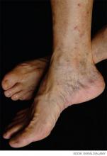 An elderly patient's feet stricken with DVT.