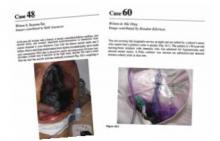 Left: Image of patient with rhino-orbital-cerebral mucormycosis, case number 48. Right: Image of patient with purple-colored urine in his Foley catheter collection bag, case number 60.